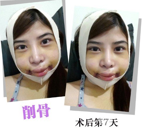 面部轮廓削骨整形术一个月恢复效果案例分享
