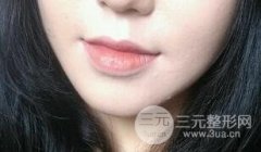 伊w兰丰下巴前后果展示图，与V脸就差一个下巴的距离！