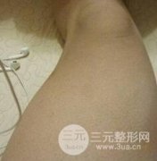 做个全身吸脂多少钱？大腿+手臂+腹部术后恢复对比图！