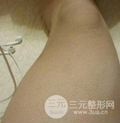 做个全身吸脂多少钱1