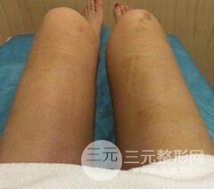 做个全身吸脂多少钱4