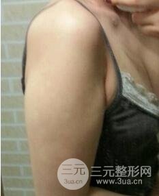 做个全身吸脂多少钱7
