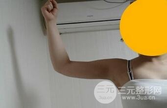 做个全身吸脂多少钱12