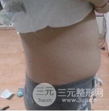 做个全身吸脂多少钱15