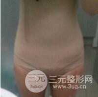 做个全身吸脂多少钱16