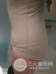 做个全身吸脂多少钱17
