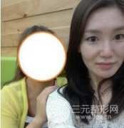 去鼻唇沟真实案例分享,年轻十岁回到小姑娘的样子! 去鼻唇沟真实案例分享,年轻十岁回到小姑娘的样子!