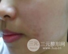 激光缓解平痘坑真实案例分享，终于填平了困扰我多年的痘坑！
