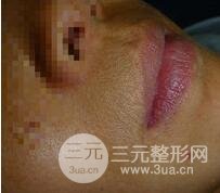 激光脱毛胡子1