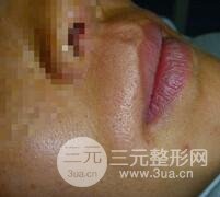 激光脱毛胡子2