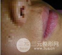 激光脱毛胡子3