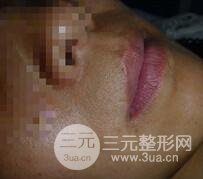 激光脱毛胡子5