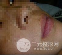 激光脱毛胡子9