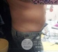 等离子光纤溶脂减肥真实案例分享，瘦下来才知道自己有多美！