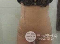 等离子光纤溶脂3