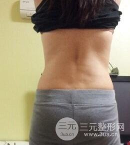 等离子光纤溶脂8