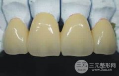 经济实惠还是要靠钯金烤瓷牙，又白又牢固果超乎想象