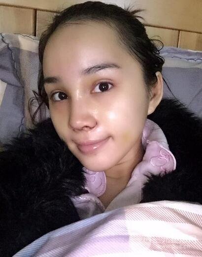 隆鼻整形多少钱？南京美梯隆鼻整形恢复日记及前后对比