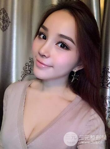 隆鼻整形多少钱？南京美梯隆鼻整形恢复日记及前后对比