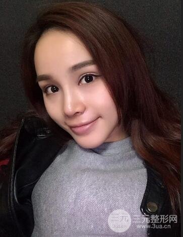 隆鼻整形多少钱？南京美梯隆鼻整形恢复日记及前后对比