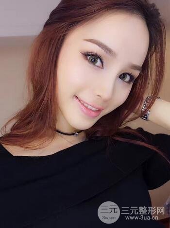 隆鼻整形多少钱？南京美梯隆鼻整形恢复日记及前后对比