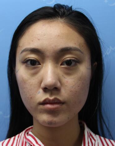 自体脂肪丰太阳穴+脸颊 南京美梯自体脂肪面部填充案例