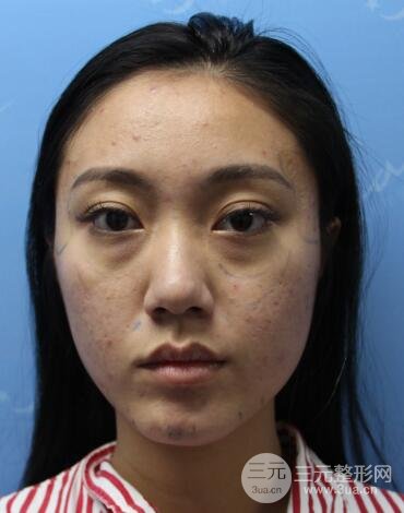 自体脂肪丰太阳穴+脸颊 南京美梯自体脂肪面部填充案例