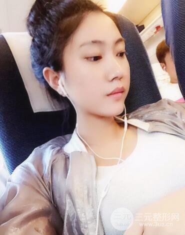 自体脂肪丰太阳穴+脸颊 南京美梯自体脂肪面部填充案例
