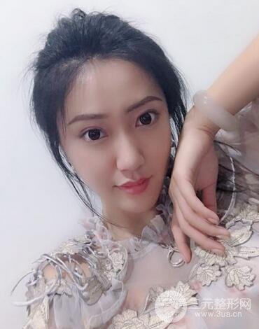 自体脂肪丰太阳穴+脸颊 南京美梯自体脂肪面部填充案例