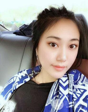 自体脂肪丰太阳穴+脸颊 南京美梯自体脂肪面部填充案例