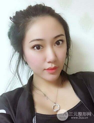 自体脂肪丰太阳穴+脸颊 南京美梯自体脂肪面部填充案例