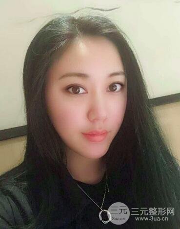 自体脂肪丰太阳穴+脸颊 南京美梯自体脂肪面部填充案例