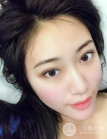 自体脂肪丰太阳穴+脸颊 南京美梯自体脂肪面部填充案例
