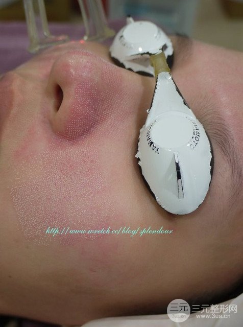 飞梭镭射多少钱飞梭镭射前后对比照片及恢复日记分享