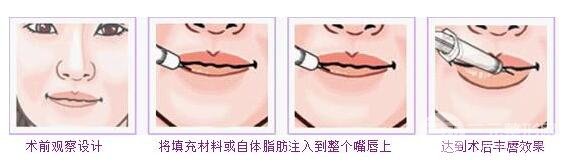 自体脂肪丰嘴唇真人案例整形手术前后果图
