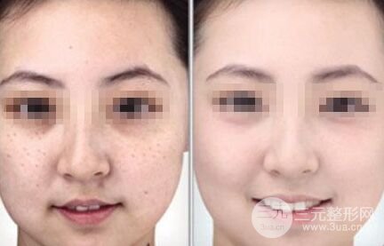 光子嫩肤去斑价格一般是多少,去斑果对比图
