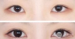 开内眼角有风险吗，开内眼角多久恢复自然