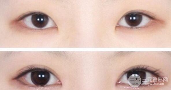 开内眼角有风险吗,开内眼角多久恢复自然