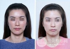 全身光子嫩肤多少钱  百里守约告诉你