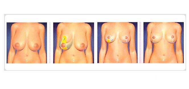 缩乳术手术方式全过程术后果图片