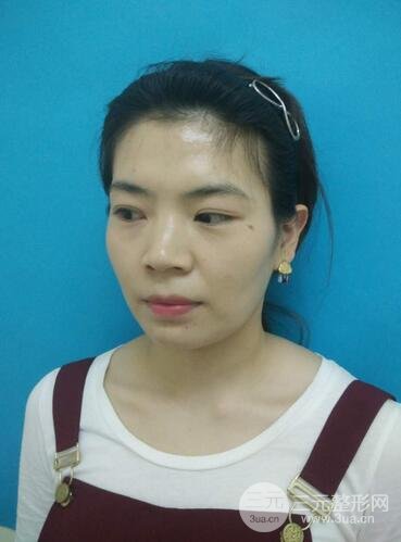 全脸自体脂肪填充前后图片 青岛琅梵亚美妍自体填充案例