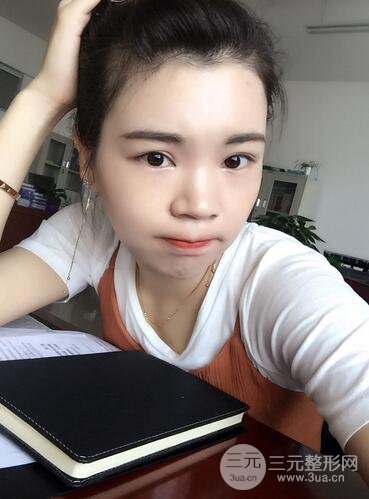 全脸自体脂肪填充前后图片 青岛琅梵亚美妍自体填充案例