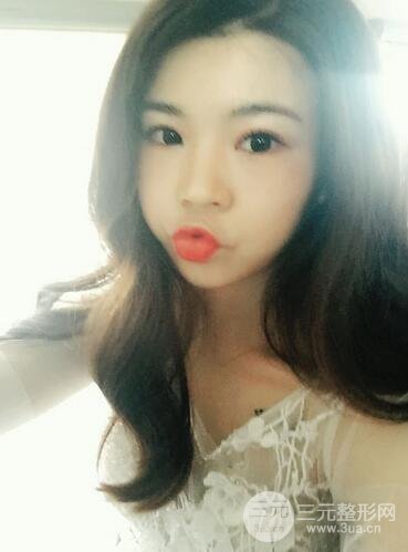 全脸自体脂肪填充前后图片 青岛琅梵亚美妍自体填充案例