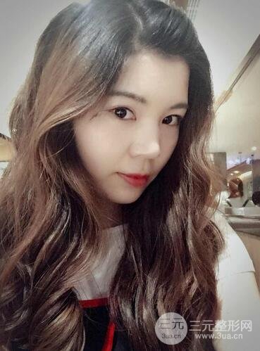 全脸自体脂肪填充前后图片 青岛琅梵亚美妍自体填充案例