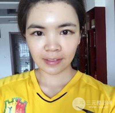 全脸自体脂肪填充前后图片 青岛琅梵亚美妍自体填充案例