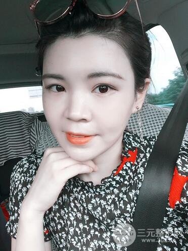全脸自体脂肪填充前后图片 青岛琅梵亚美妍自体填充案例