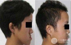 【上颌后缩】上颌后缩矫正手术缓解方法和价格
