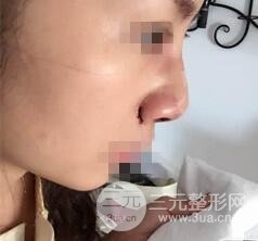 鼻梁宽3