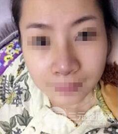 鼻梁宽6