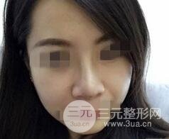 鼻梁宽7
